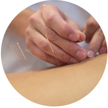 Skilled acupuncture treatment