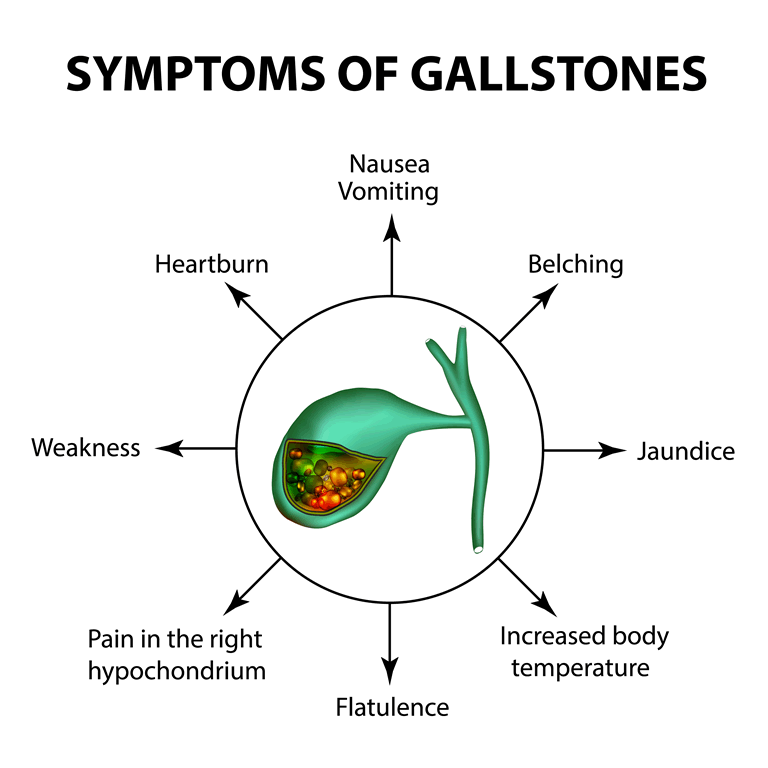 symptoms of gallstones