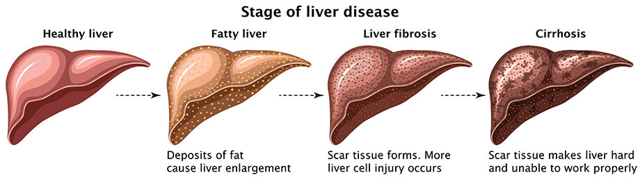 Stages of liver disease